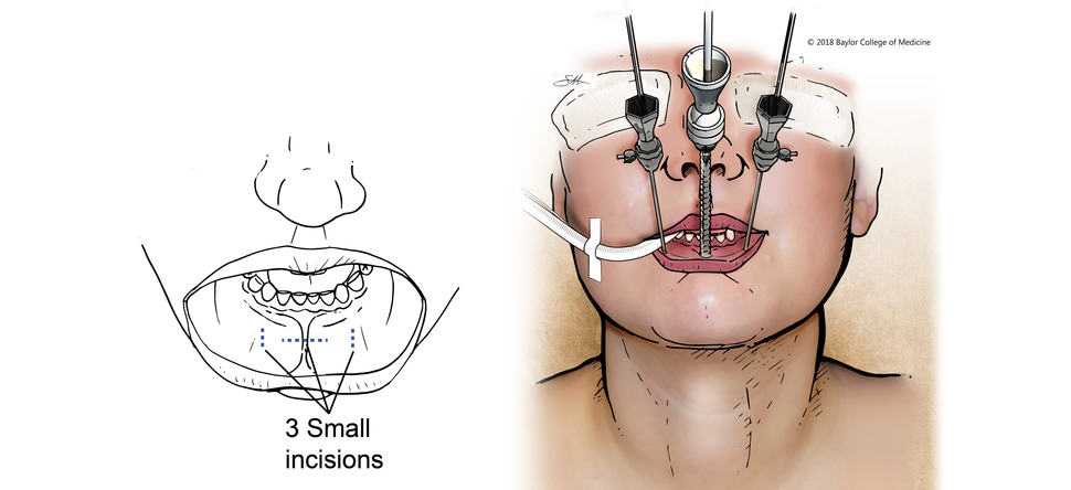 T.O.E.T.V.A. (Transoral Endoscopic Thyroidectomy Vestibular Approach)